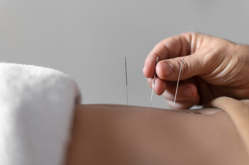 O papel da acupunctura no tratamento de dor crônica